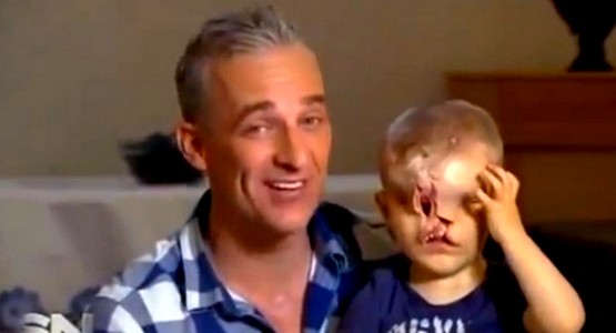 أطباء أستراليون ينجحون في إجراء عملية لطفل تطواني وُلد بدون وجه
