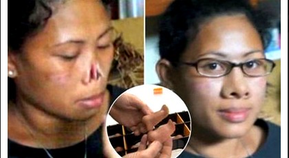 سيدة اندونيسية تحصل على أنف اصطناعية بعد ان قطع زوجها انفها الاصلي