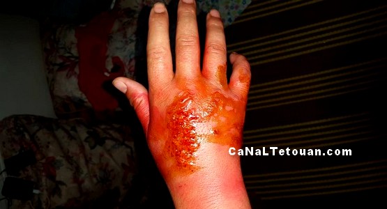 تقرحات في يد فتاة بعد اصابتها بلسعة سامة من قنديل البحر بشواطئ تطوان (صور)